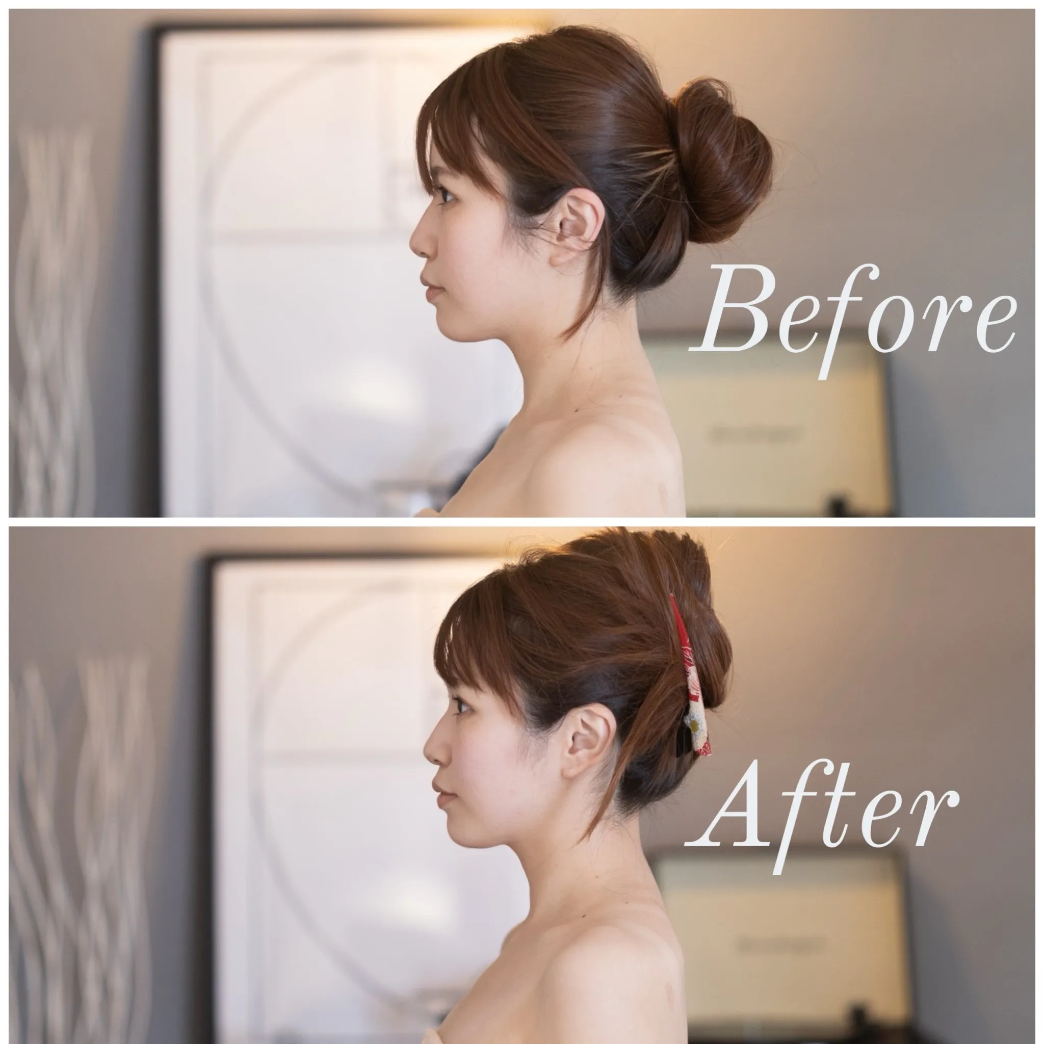 美容鍼のBefore After②