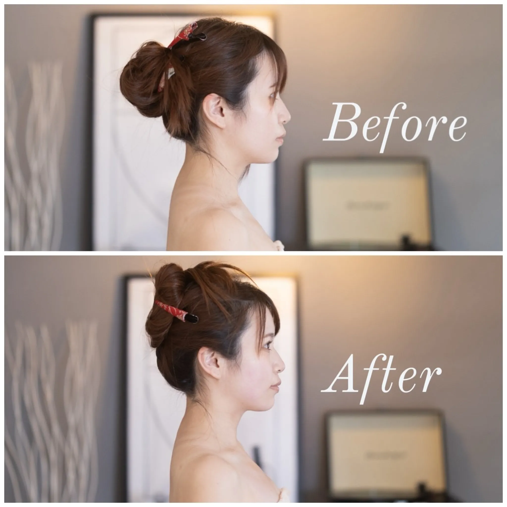 美容鍼のBefore After③